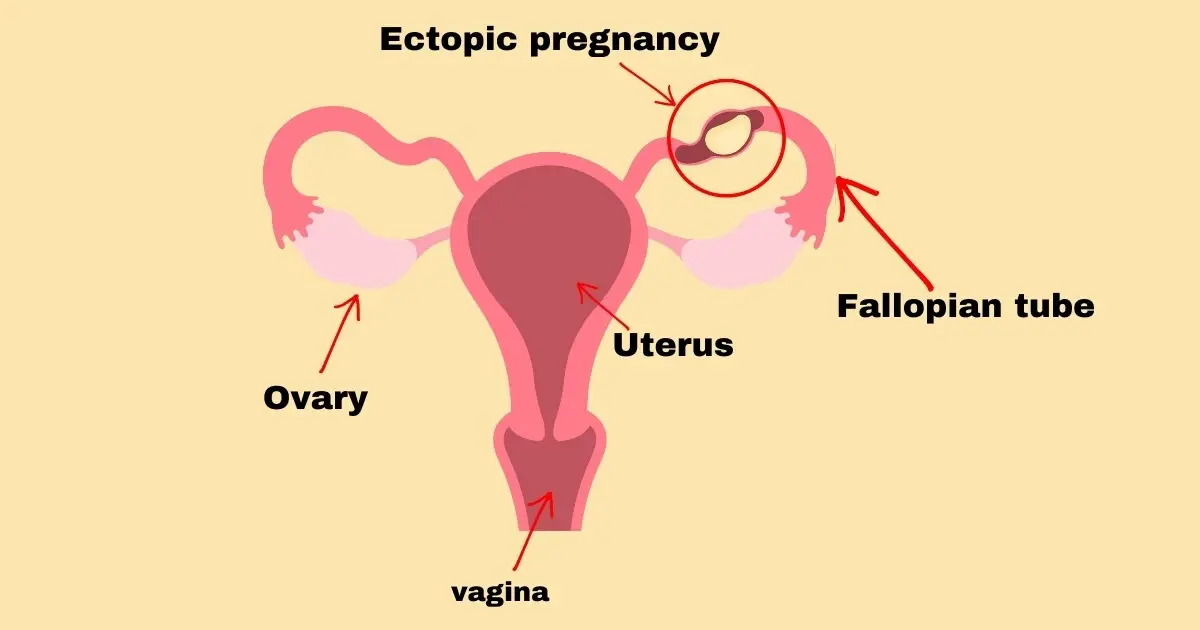 Ectopic Pregnancy