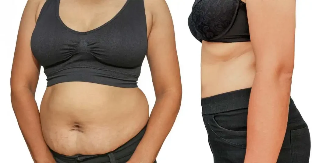 Abdomen Liposuction Before and After