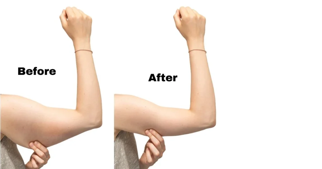 Arm Liposuction Before and After