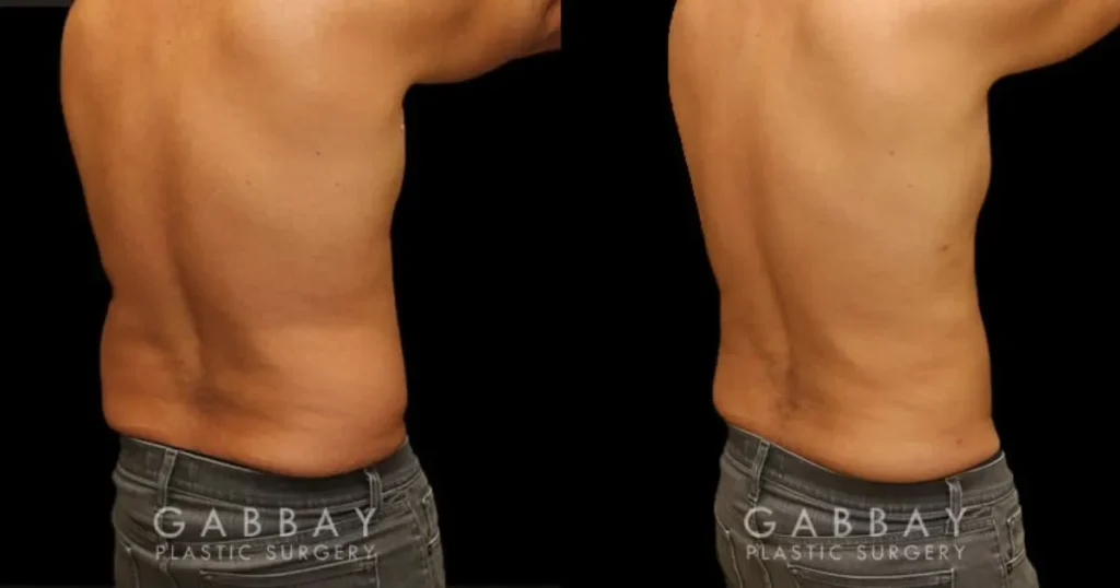 Back Liposuction Before and After