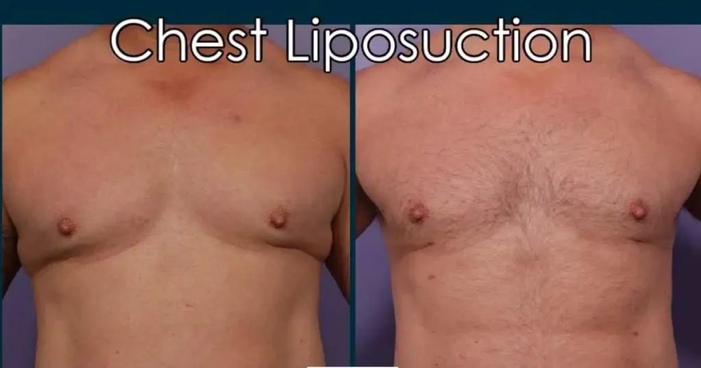 Chest Liposuction Before and After