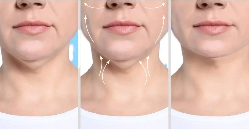 Chin Liposuction Before and After