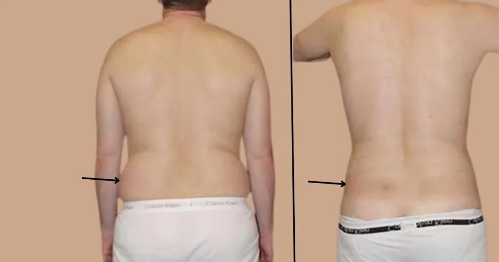 Flanks Liposuction Before and After