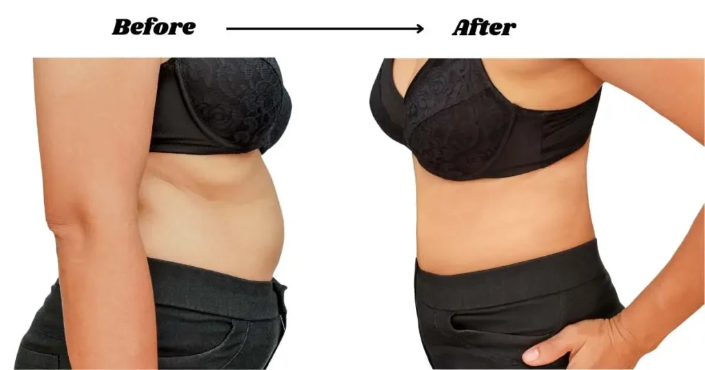 Liposuction Before and After Comparisons