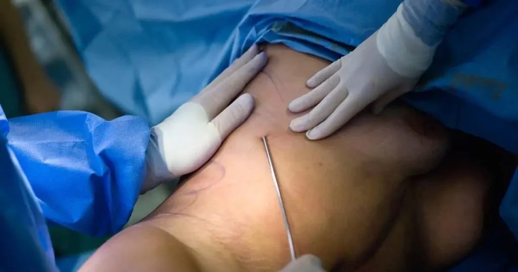 Tumescent Liposuction